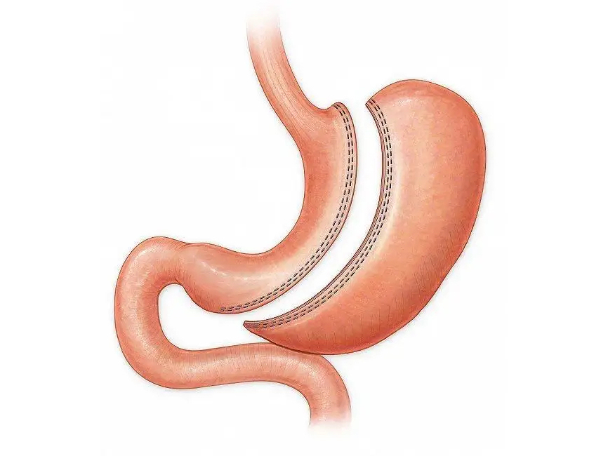 袖状胃切除手术介绍