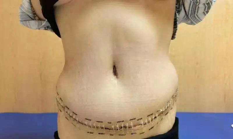 腹壁成形术——大肚腩也可以成为“小腰精”