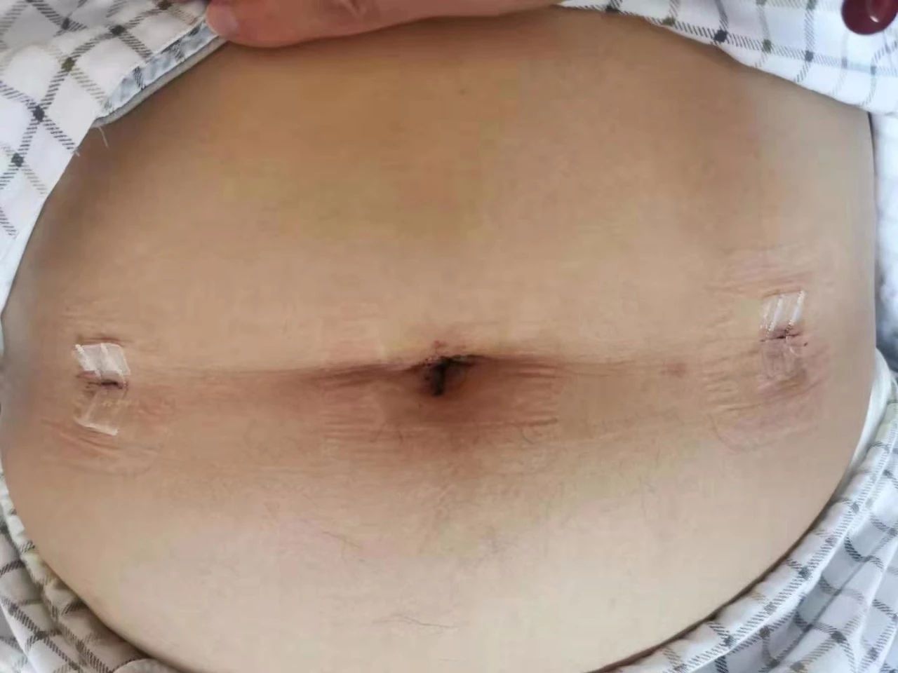 对称三孔袖状胃手术/胃旁路手术术后第一天切口图