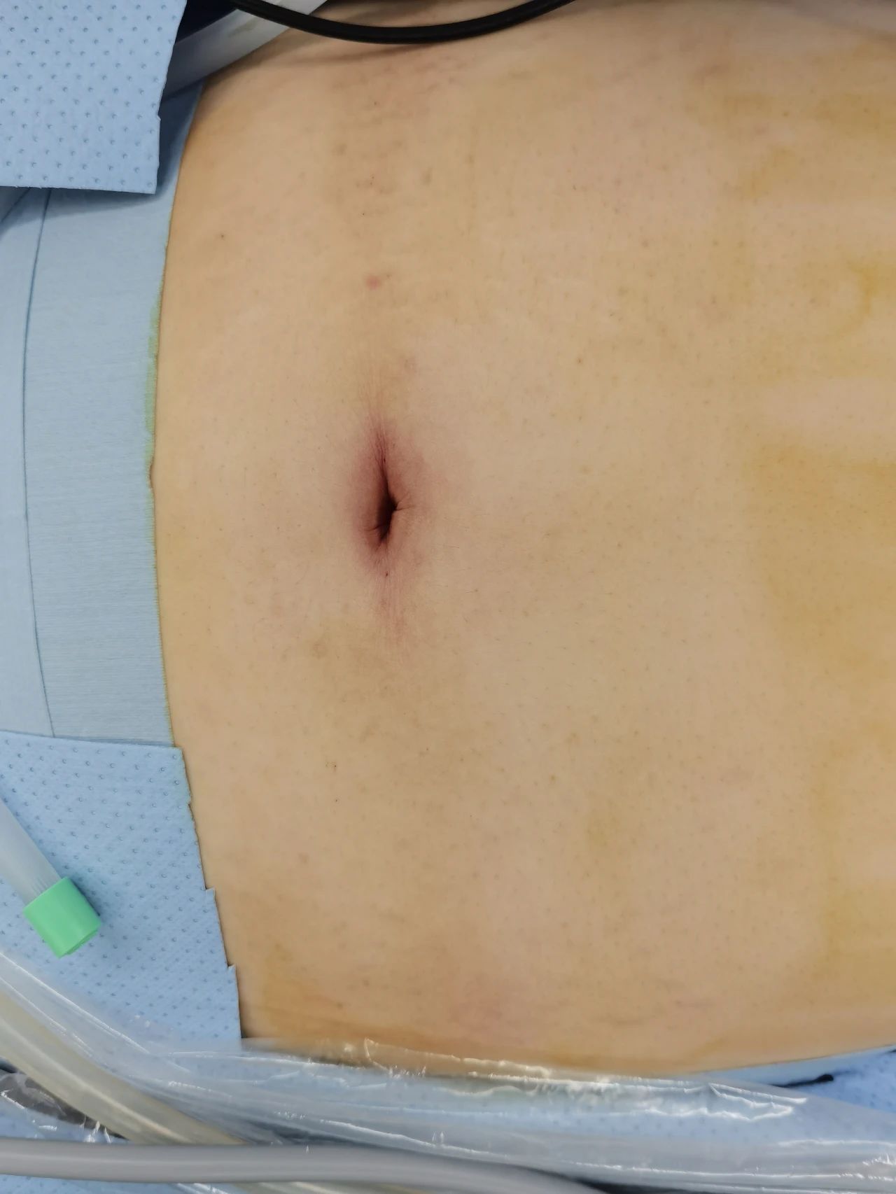 直径2cm的单孔减重糖尿病手术切口图